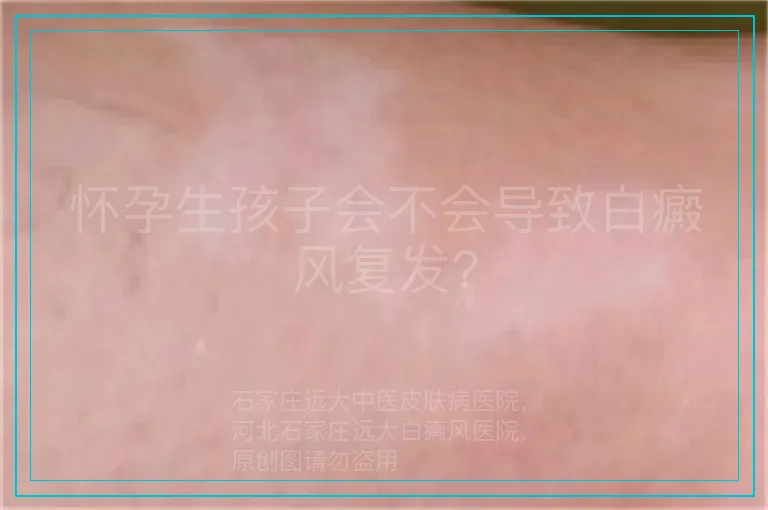 怀孕生孩子会不会导致白癜风复发?