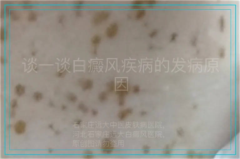 谈一谈白癜风疾病的发病原因