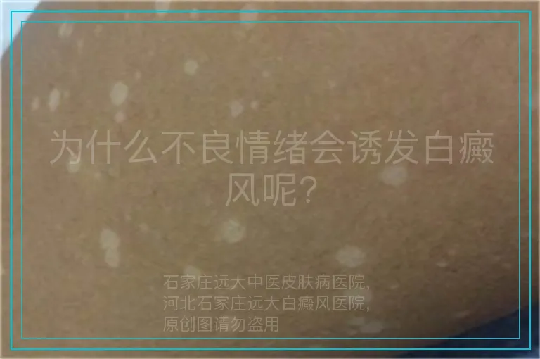 为什么不良情绪会诱发白癜风呢?