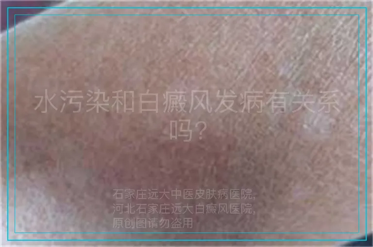 水污染和白癜风发病有关系吗?