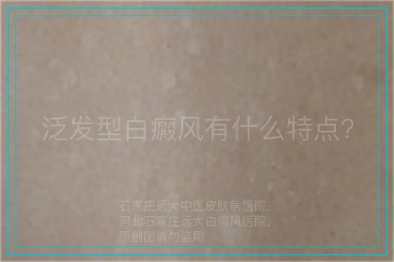 泛发型白癜风有什么特点?