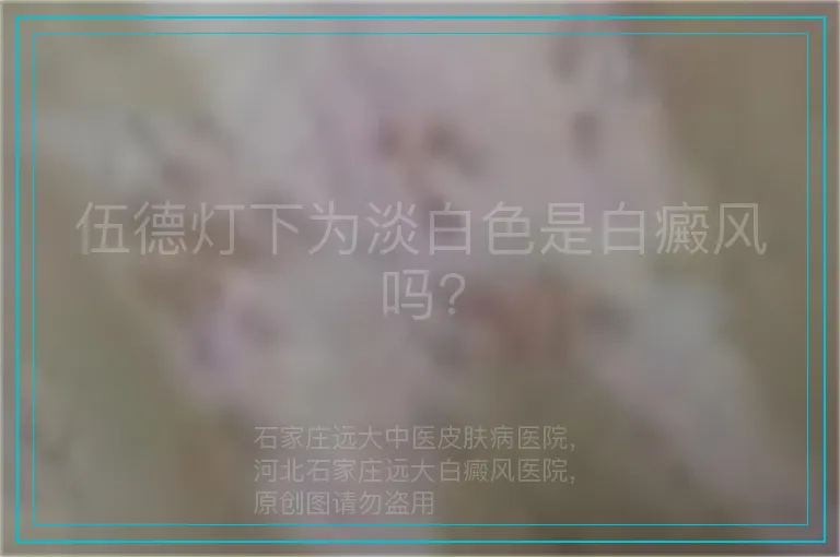 伍德灯下为淡白色是白癜风吗?