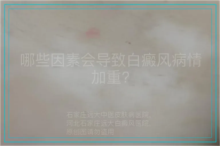 哪些因素会导致白癜风病情加重?