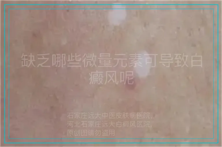 缺乏哪些微量元素可导致白癜风呢