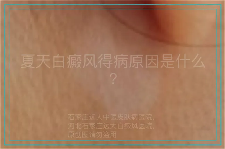 夏天白癜风得病原因是什么?