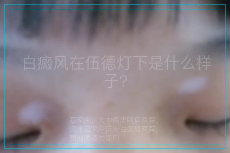 白癜风在伍德灯下是什么样子?