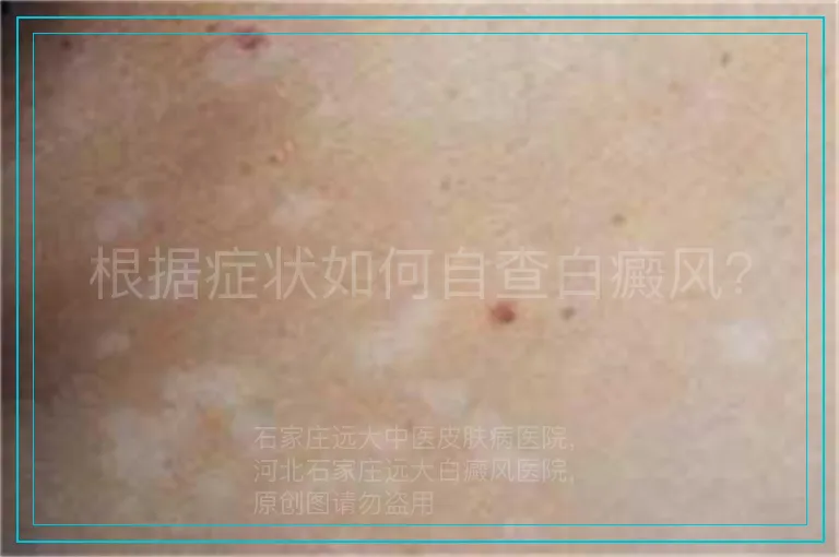 根据症状如何自查白癜风？