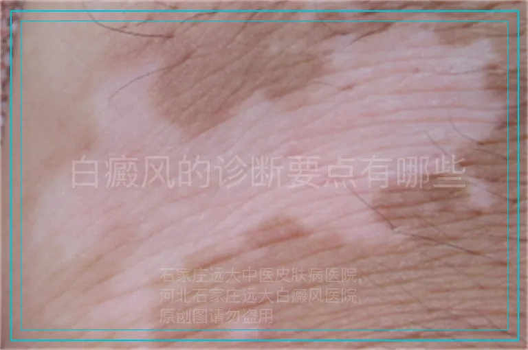 白癜风的诊断要点有哪些