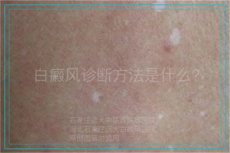 白癜风诊断方法是什么？