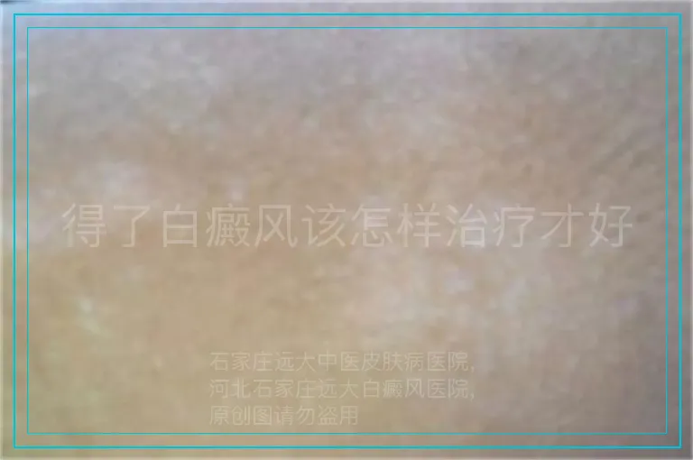 得了白癜风该怎样治疗才好
