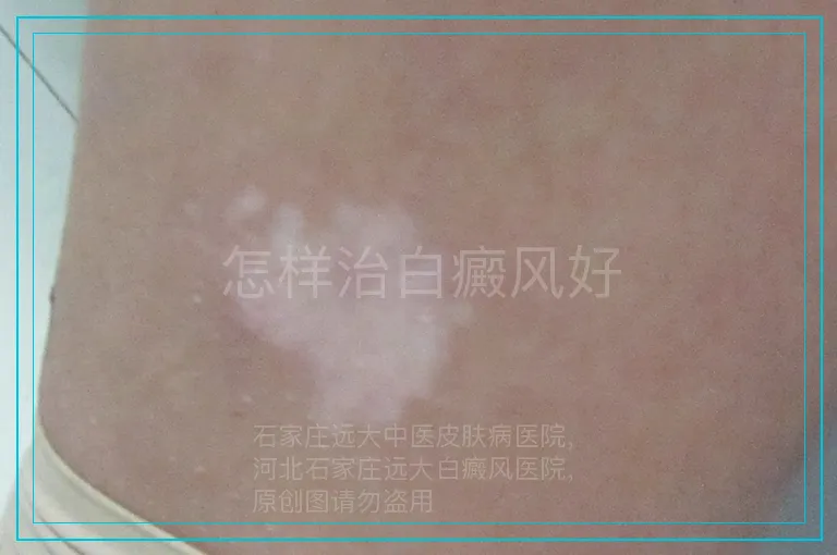 怎样治白癜风好