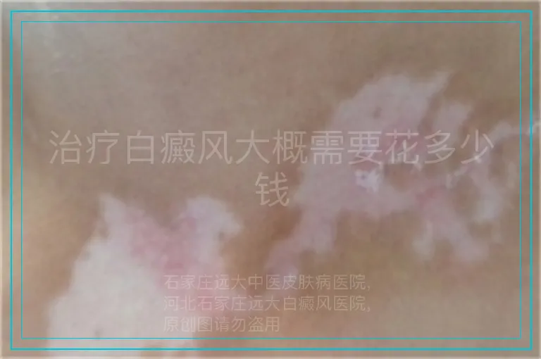 治疗白癜风大概需要花多少钱