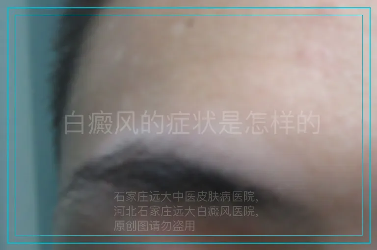 白癜风的症状是怎样的