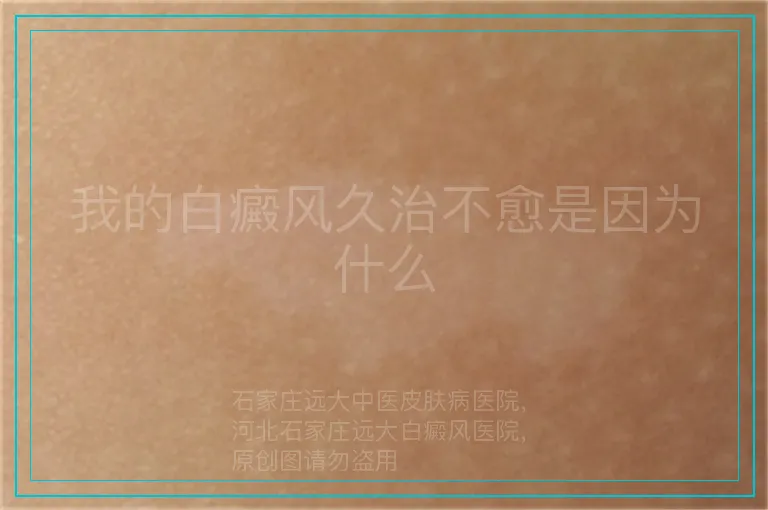 我的白癜风久治不愈是因为什么