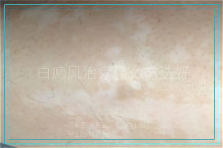 白癜风治疗什么方法好