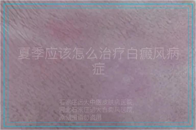 夏季应该怎么治疗白癜风病症