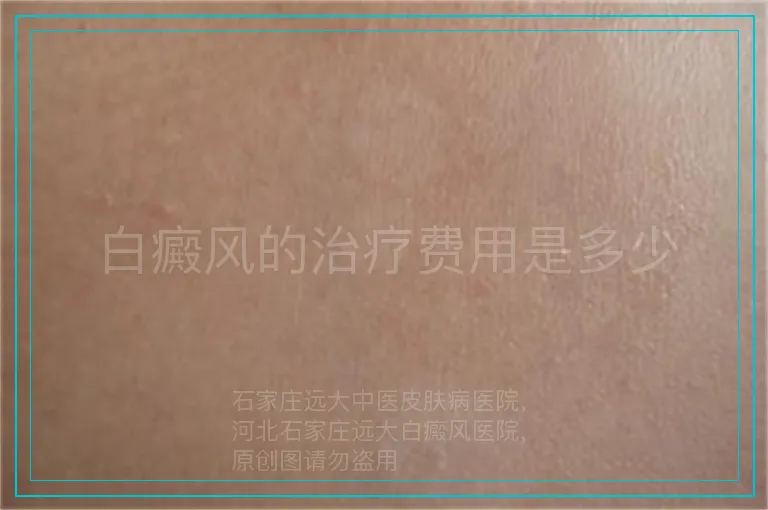 白癜风的治疗费用是多少