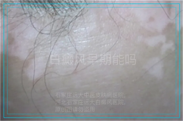 白癜风早期能吗