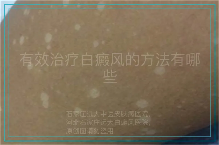 有效治疗白癜风的方法有哪些