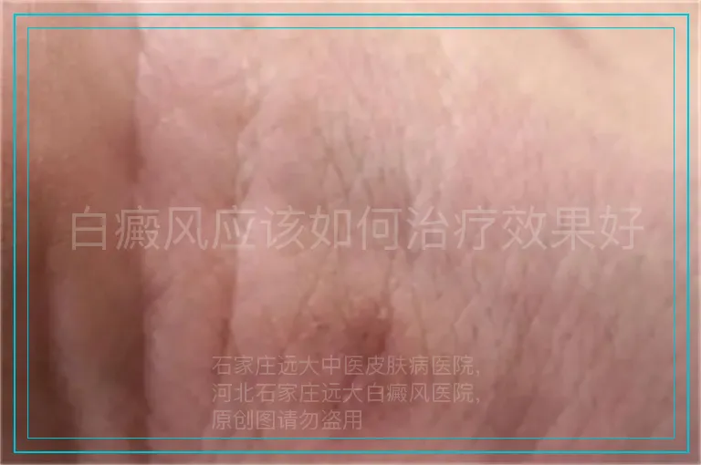 白癜风应该如何治疗效果好