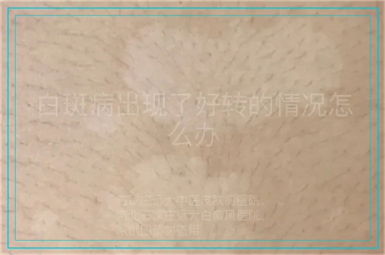 白斑病出现了好转的情况怎么办