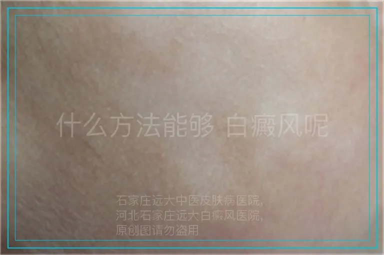 什么方法能够 白癜风呢