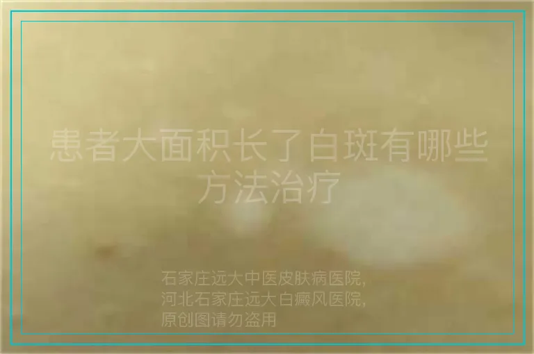 患者大面积长了白斑有哪些方法治疗