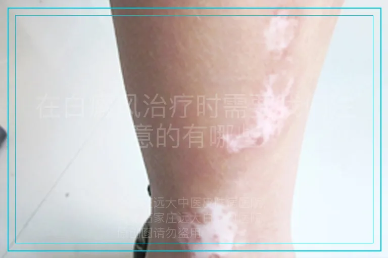 在白癜风治疗时需要我们注意的有哪些