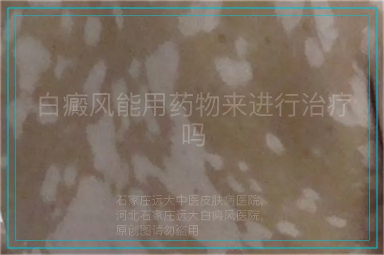 白癜风能用药物来进行治疗吗