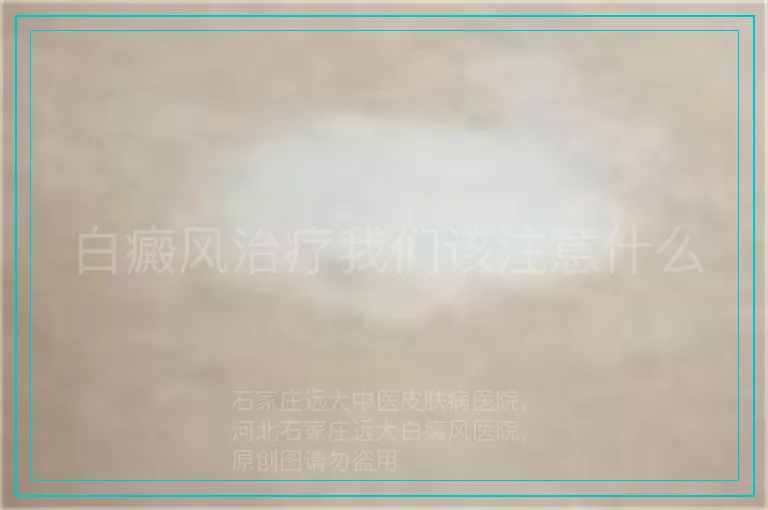 白癜风治疗我们该注意什么