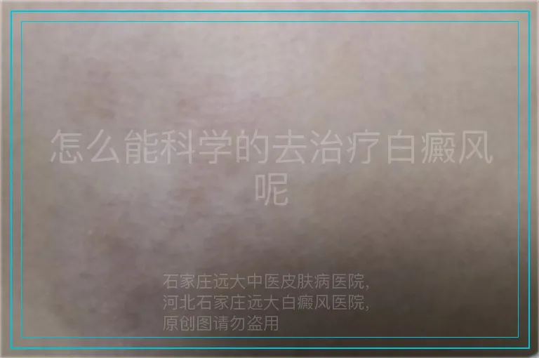 怎么能科学的去治疗白癜风呢