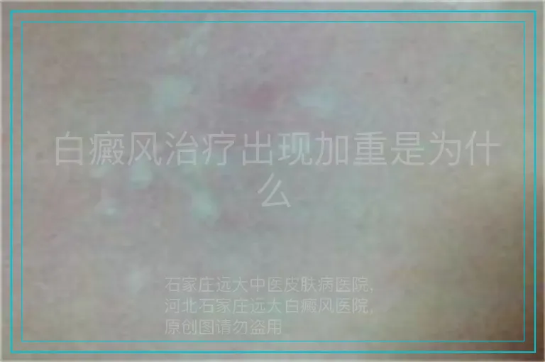 白癜风治疗出现加重是为什么