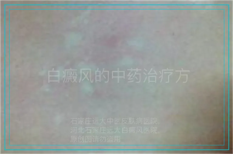 白癜风的中药治疗方