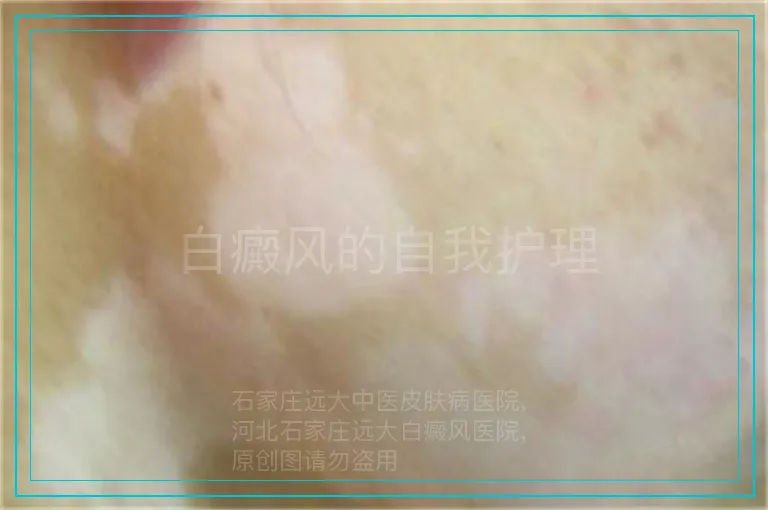 白癜风的自我护理