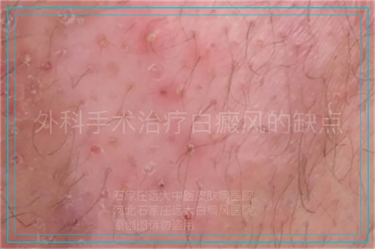 外科手术治疗白癜风的缺点