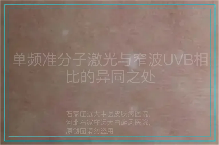 单频准分子激光与窄波UVB相比的异同之处