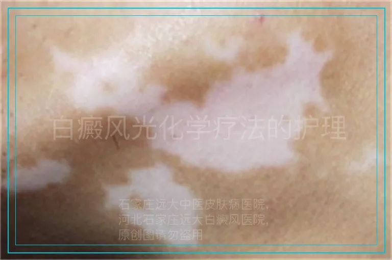 白癜风光化学疗法的护理