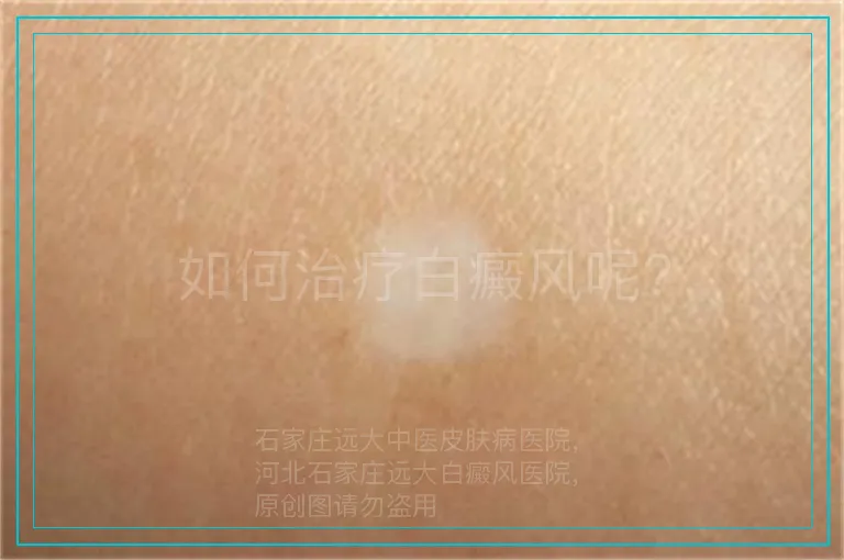 如何治疗白癜风呢?