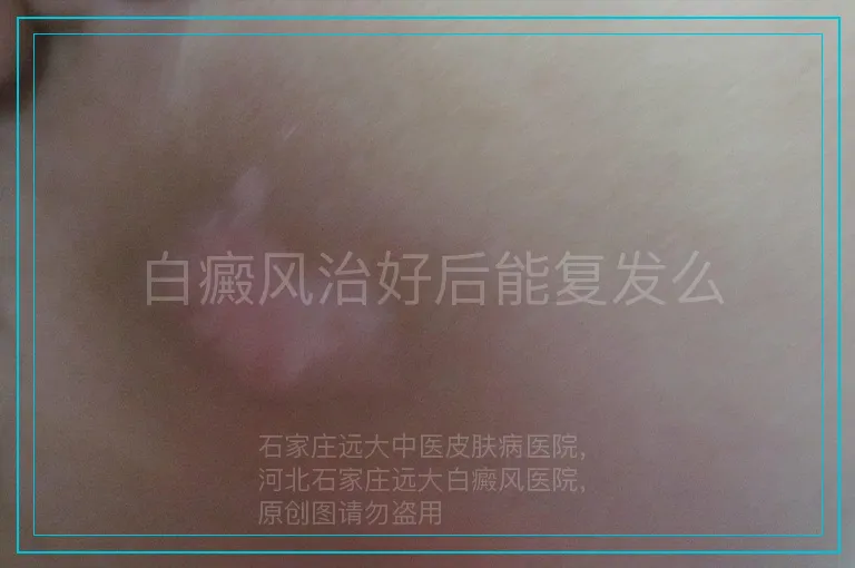 白癜风治好后能复发么