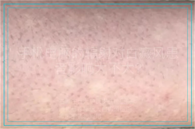 手机电脑的辐射对白癜风患者影响大不大?