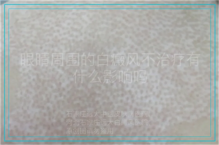 眼睛周围的白癜风不治疗有什么影响吗