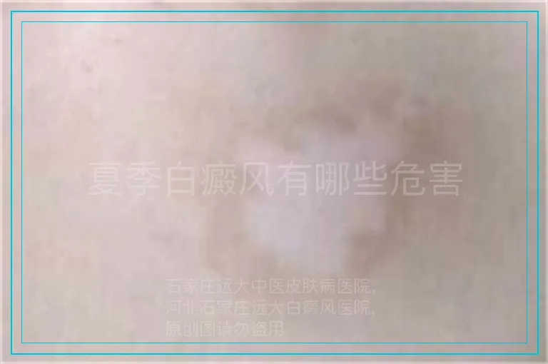 夏季白癜风有哪些危害