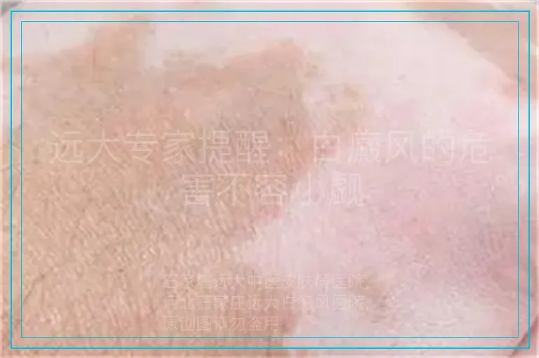 远大专家提醒：白癜风的危害不容小觑