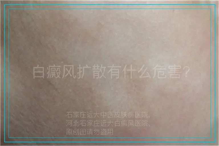 白癜风扩散有什么危害?