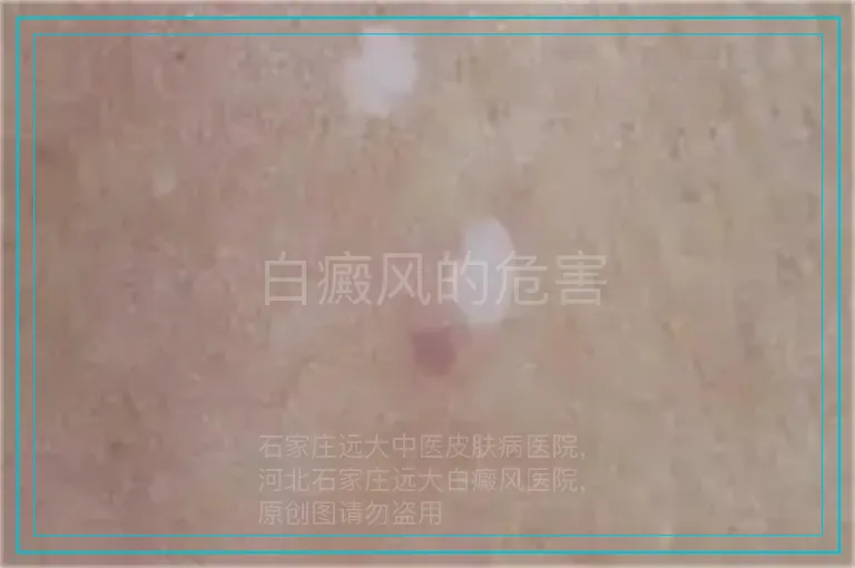 白癜风的危害