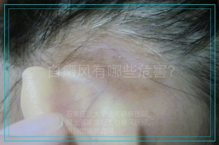白癜风有哪些危害？