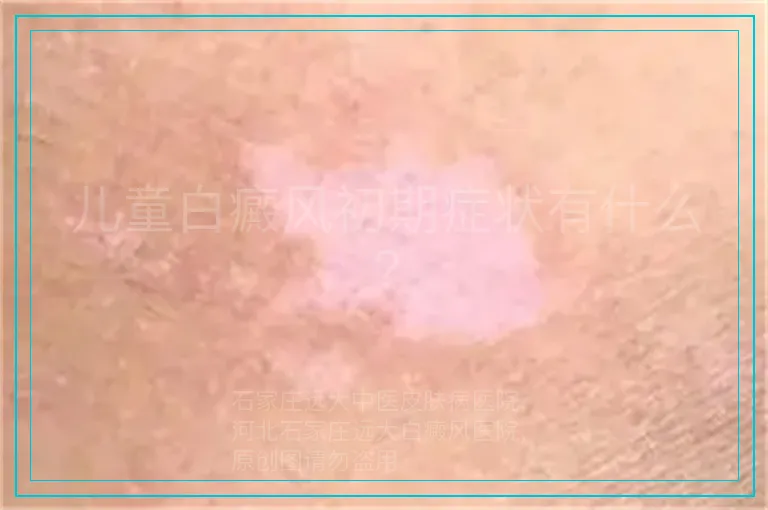儿童白癜风初期症状有什么?