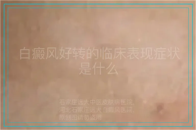 白癜风好转的临床表现症状是什么