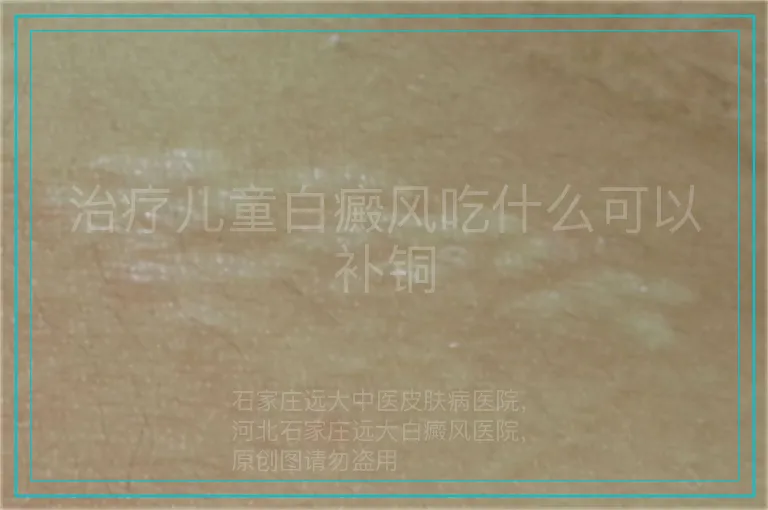 治疗儿童白癜风吃什么可以补铜