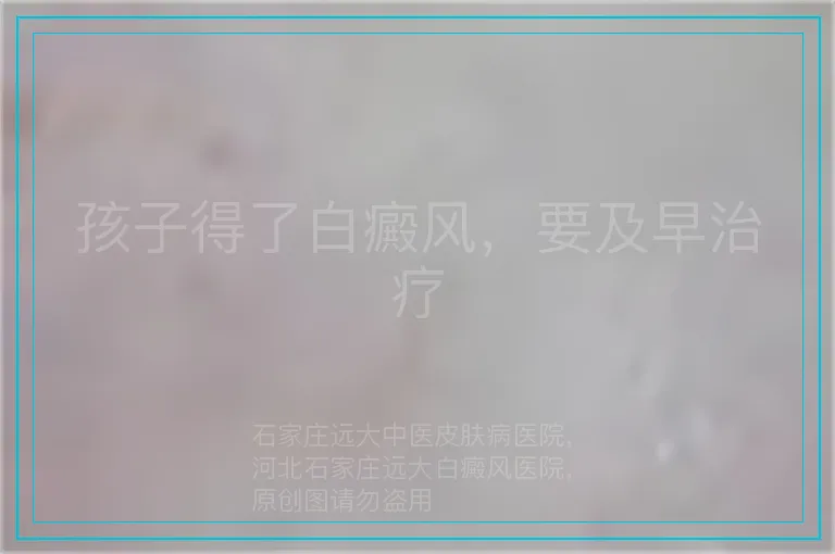 孩子得了白癜风，要及早治疗
